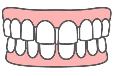 空隙歯列のイラスト